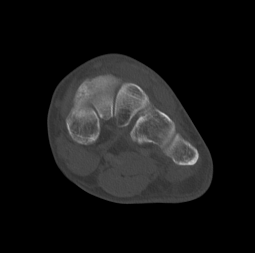 Anterior calcaneal process fracture (Radiopaedia 47384-51989 Coronal bone window 45).png