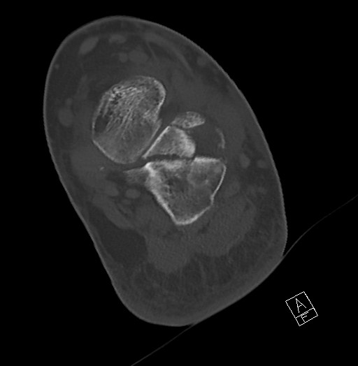 Anterior calcaneal process fracture (Radiopaedia 63353-71943 Axial bone window 94).jpg