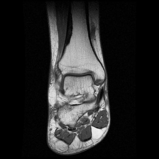File:Anterior calcaneal process fracture (Radiopaedia 71377-81705 Coronal T1 7).jpg