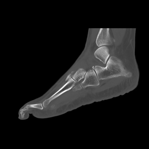 File:Anterior calcaneal process fracture (Radiopaedia 82590-96762 Sagittal bone window 18).jpg
