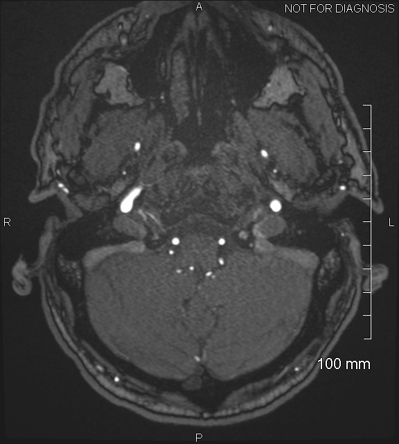 Anterior cerebral artery aneurysm (Radiopaedia 80683-94127 Axial MRA 26).jpg
