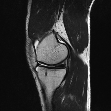 File:Anterior cruciate ligament full thickness tear (Radiopaedia 66268-75467 Sagittal T2 8).jpg