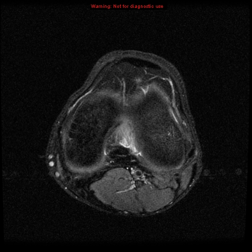 File:Anterior cruciate ligament injury - partial thickness tear (Radiopaedia 12176-12515 Axial PD 15).jpg