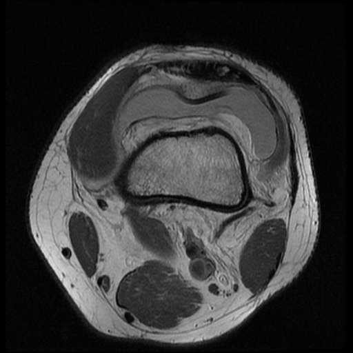 File:Anterior cruciate ligament tear (Radiopaedia 61500-69462 Axial PD 2).jpg