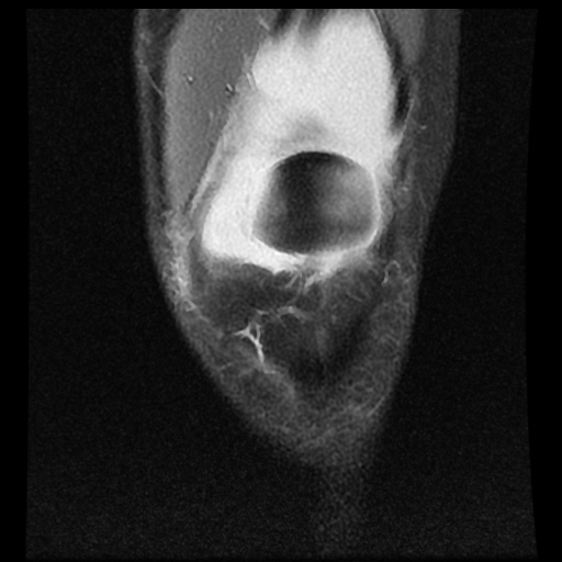 File:Anterior cruciate ligament tear (Radiopaedia 61500-69462 Coronal PD fat sat 3).jpg