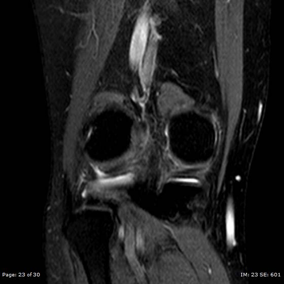 File:Anterior cruciate ligament tear (Radiopaedia 70783-80964 Coronal STIR 23).jpg