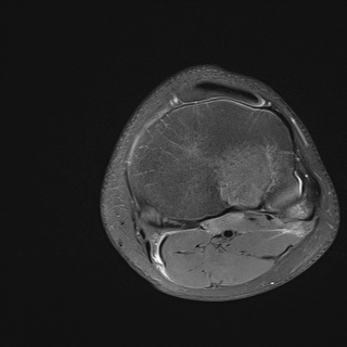 File:Anterior cruciate ligament tear - pediatric (Radiopaedia 62152-70260 Axial PD fat sat 30).jpg