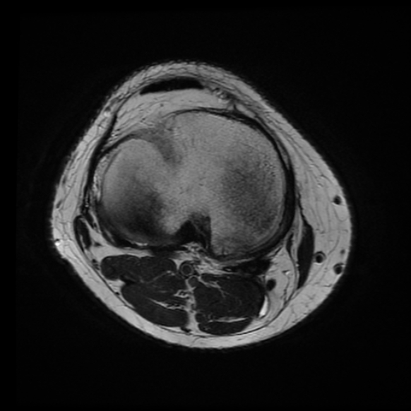 File:Anterior cruciate ligament tear with posteromedial corner injury, bucket-handle meniscal tear and chondral delamination (Radiopaedia 75501-86744 Axial T2 7).jpg