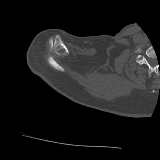 File:Anterior glenohumeral dislocation with Hill-Sachs lesion (Radiopaedia 62877-71249 Axial bone window 9).jpg