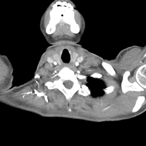 Anterior mediastinal lymphoma (Radiopaedia 29556-30061 C 3).jpg