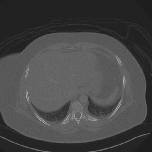 Anterior superior iliac spine avulsion fracture (Radiopaedia 44541-48244 Axial bone window 16).png