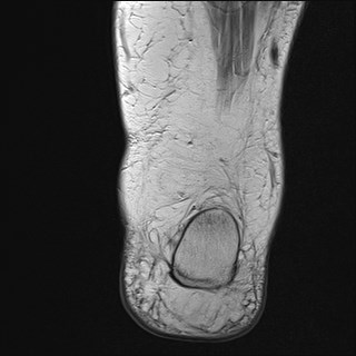File:Anterior talofibular ligament injury - rupture with soft-tissue impingement (Radiopaedia 38765-40928 Coronal PD 6).jpg