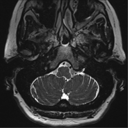 Anterior temporal pole cysts (Radiopaedia 46629-51102 Axial T2 13).png
