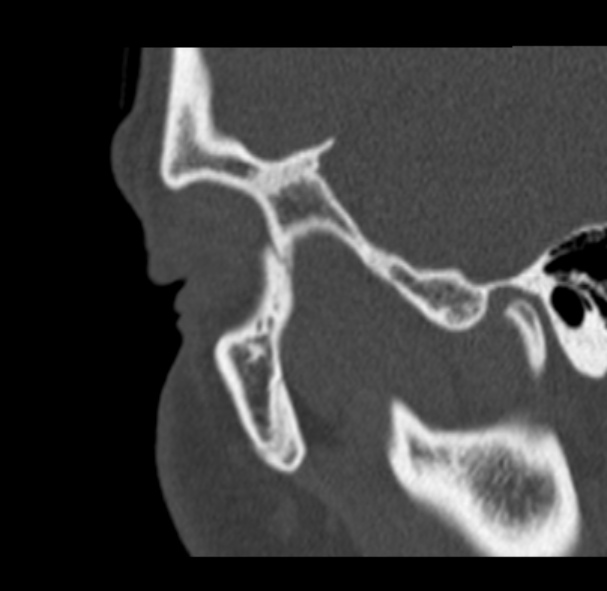 Antrochoanal polyp (Radiopaedia 33984-35202 Sagittal bone window 1).jpg