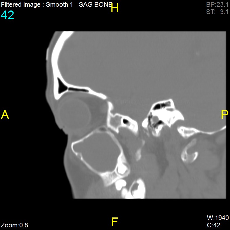 Antrochoanal polyp (Radiopaedia 65101-74094 Sagittal bone window 42).jpg