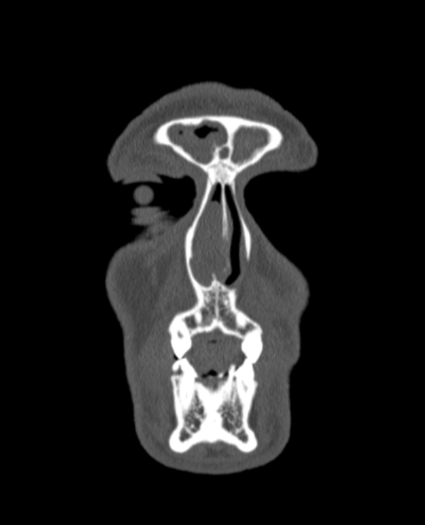 Antrochoanal polyp (Radiopaedia 79011-92169 Coronal bone window 80).jpg