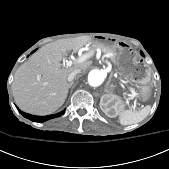 File:Aortic aneurysm with spinal destruction (Radiopaedia 42301-45410 A 22).jpg