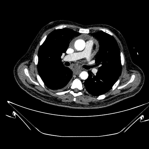 Aortic arch aneurysm (Radiopaedia 84109-99365 B 295).jpg