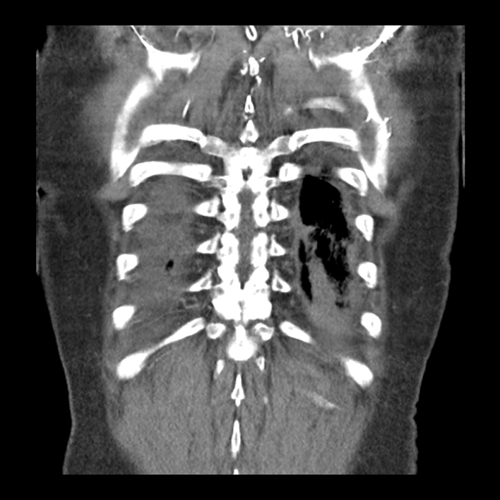 Aortic arch graft infection (FDG PET-CT) (Radiopaedia 71975-82437 Coronal 53).jpg
