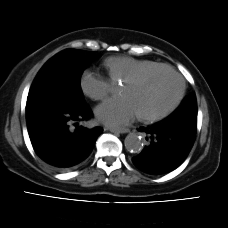 Aortic arch pseudoaneurysm (Radiopaedia 8534-9368 Axial non-contrast 48).jpg