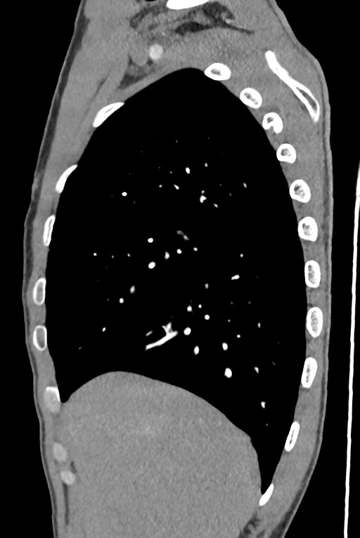 Aortic coarctation with aneurysm (Radiopaedia 74818-85828 B 40).jpg