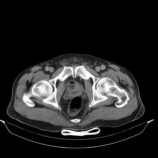 File:Aortic dissection- Stanford type A (Radiopaedia 22085-22085 Axial C+ delayed 52).jpg