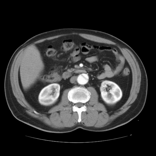 Aortic dissection (Radiopaedia 44411-48061 C 35).jpg
