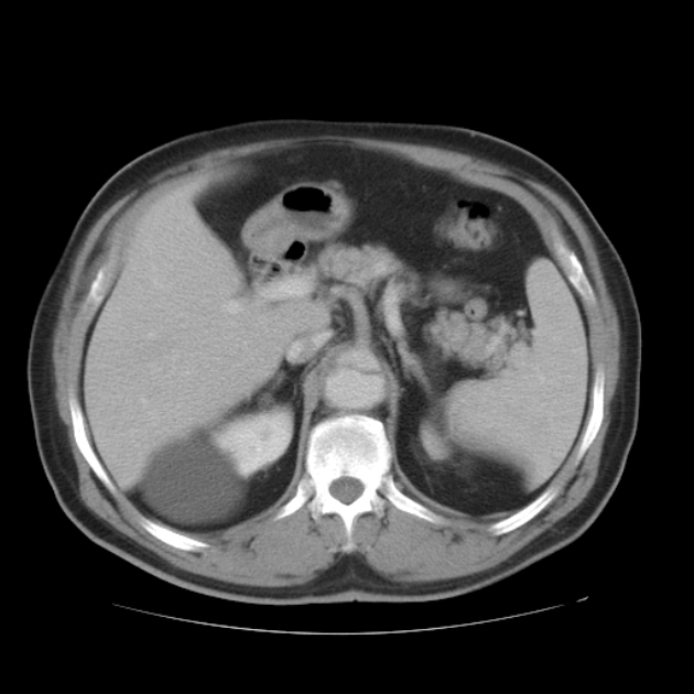 Aortic dissection (Radiopaedia 44411-48061 C 74).jpg