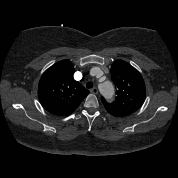 File:Aortic dissection (Radiopaedia 57969-64959 A 80).jpg