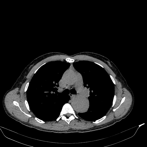 File:Aortic dissection - Stanford type A (Radiopaedia 83418-98500 Axial non-contrast 17).jpg