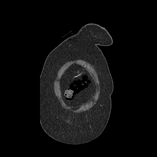 Aortic dissection - Stanford type B (Radiopaedia 88281-104910 B 3).jpg