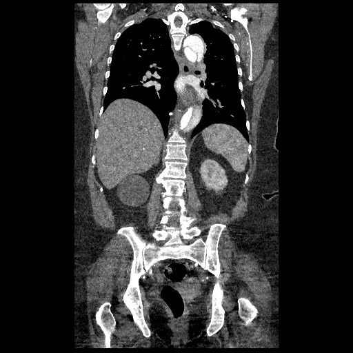 File:Aortic dissection - Stanford type B (Radiopaedia 88281-104910 B 56).jpg