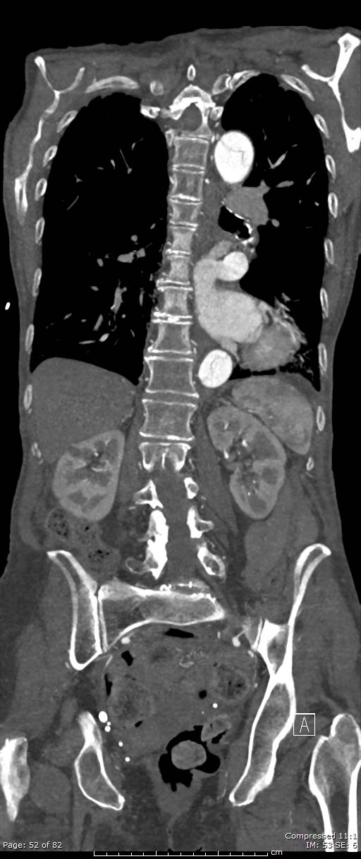 Aortic dissection with extension into aortic arch branches (Radiopaedia 64402-73204 A 52).jpg