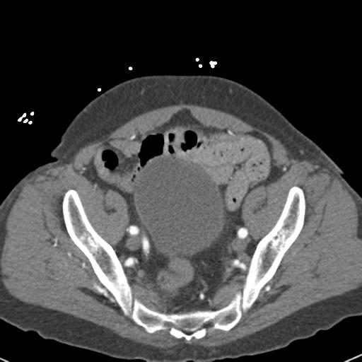 Aortic intramural hematoma (Radiopaedia 31139-31838 B 147).jpg