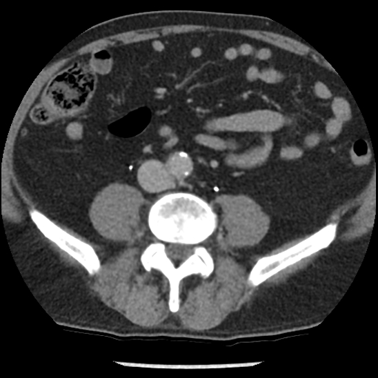 File:Aortic intramural hematoma (type B) (Radiopaedia 79323-92387 Axial C+ delayed 83).jpg