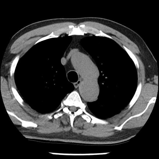 Aortic intramural hematoma (type B) (Radiopaedia 79323-92387 Axial non-contrast 13).jpg