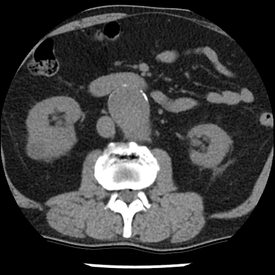 Aortic intramural hematoma (type B) (Radiopaedia 79323-92387 Axial non-contrast 71).jpg