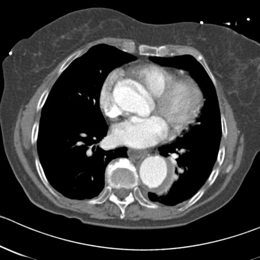 Aortic intramural hematoma from penetrating atherosclerotic ulcer (Radiopaedia 31137-31836 A 49).jpg