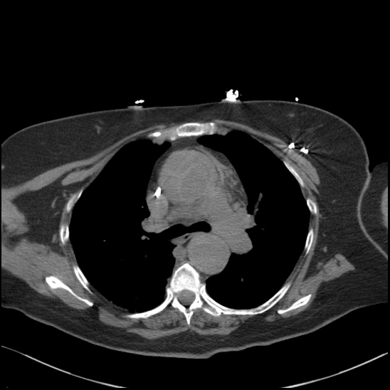 Aortic intramural hematoma with dissection and intramural blood pool (Radiopaedia 77373-89491 Axial non-contrast 38).jpg
