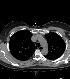 Aortic valve endocarditis (Radiopaedia 87209-103485 Axial non-contrast 31).jpg