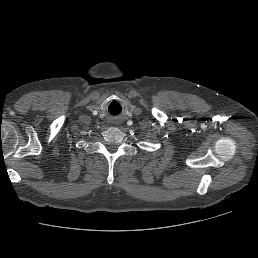 File:Aorto-coronary bypass graft aneurysms (Radiopaedia 40562-43157 A 11).png