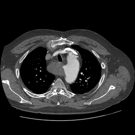 File:Aorto-coronary bypass graft aneurysms (Radiopaedia 40562-43157 A 30).png