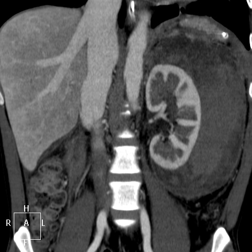 Aorto-left renal vein fistula (Radiopaedia 45534-49628 B 38).jpg