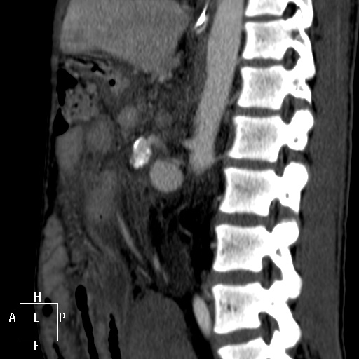 File:Aorto-left renal vein fistula (Radiopaedia 45534-49628 C 40).jpg