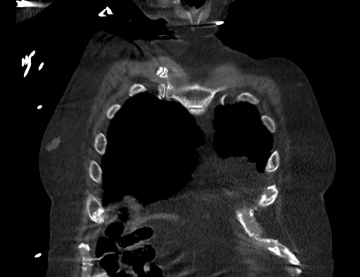 Aortoesophageal fistula with endovascular repair (Radiopaedia 73781-84592 Coronal C+ CTPA 10).jpg
