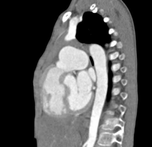 File:Aortopulmonary window, interrupted aortic arch and large PDA giving the descending aorta (Radiopaedia 35573-37074 C 23).jpg