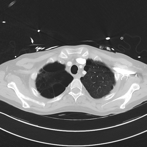 Apical bullous disease in a heavy smoker (Radiopaedia 33067-34092 Axial lung window 12).png