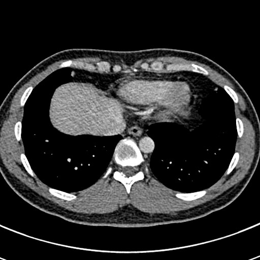 Apical lung mass mimic - neurogenic tumor (Radiopaedia 59918-67521 A 64).jpg