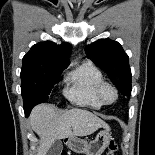 File:Apical lung mass mimic - neurogenic tumor (Radiopaedia 59918-67521 B 42).jpg