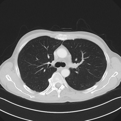 Apical pleural calcification (Radiopaedia 46141-50499 Axial lung window 25).png